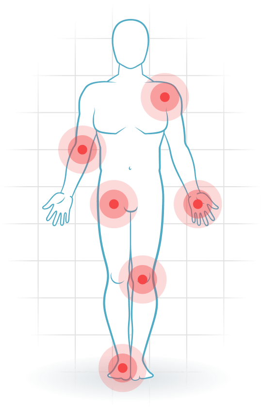 pijnlocatie Fibromialgia