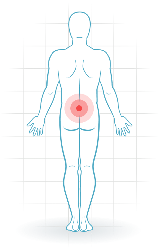 pijnlocatie Inestabilidad lumbar