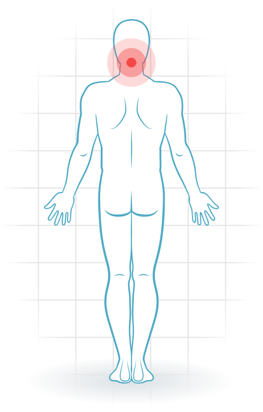 pijnlocatie Síndrome facetario cervical