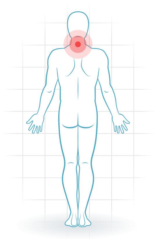 pijnlocatie Síndrome postural cervical